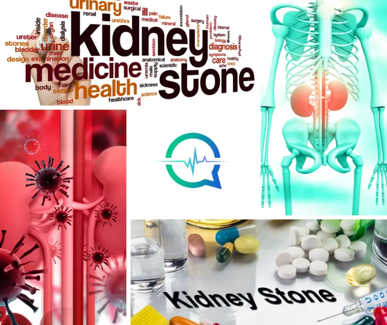 Kidney Stones Treatment, Symptoms, Causes, Prevention ? -Secondmedic