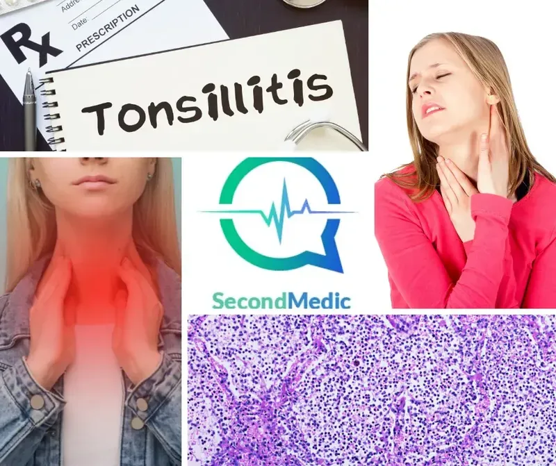 Tonsillitis Causes, Symptoms, Diagnosis & Treatment
